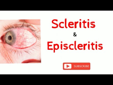 Scleritis and Episcleritis Difference || Ocular Disease || Optometry Club ||