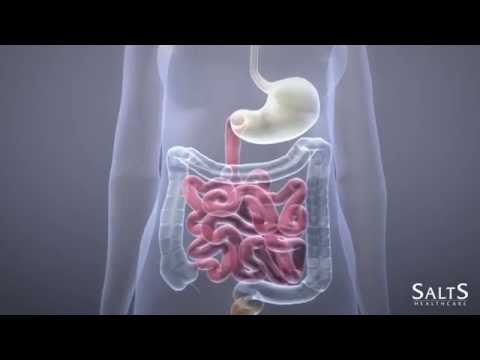 Video: Când este indicată colostomia?