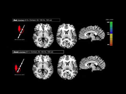 7th Annual TMII Symposium - 2017 - Session I - Neuroimaging - Dr Kendall Lee