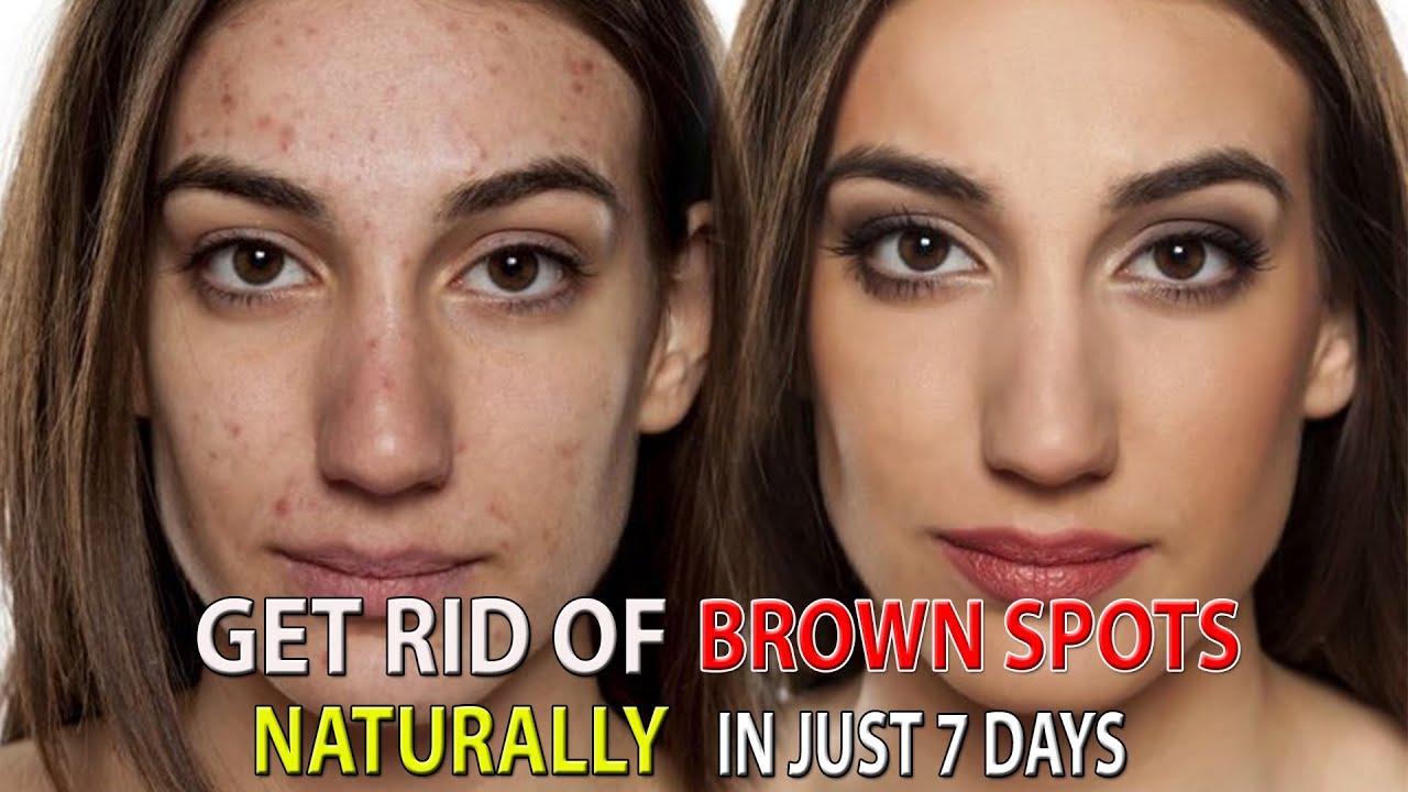 How to Remove Brown Spots Naturally In Just 7 DaysHealth Solution