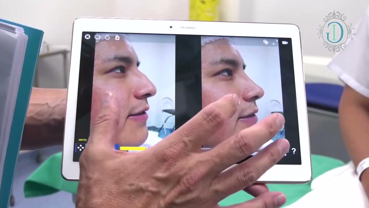 Rinoplastia | Dr. Iván Guanilo | Especialista en rinoplastia | Cirugía Plástica | Cirugía Nariz