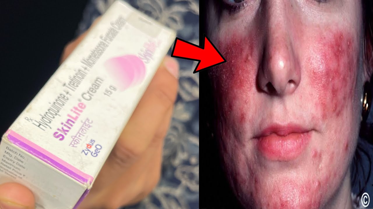 Skinlite Cream बिन side effects के use karo ! skinlite cream ke side effects se kaisebache