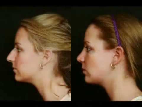 Video thumbnail: Rhinoplasty - New Jersey - Dr. Alvin Glasgold · The Glasgold Group