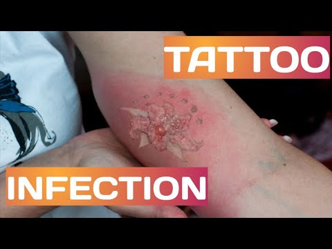 Tattoo Infection Tips For Identification And Treatment