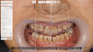 3Shape Smile Designer 를 이용한 전치부 치료 2D 시뮬레이션