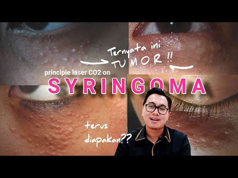 SYRINGOMA, Yakin bisa dilaser? | Review & On the spot treatment dr. Irfan Prasetya