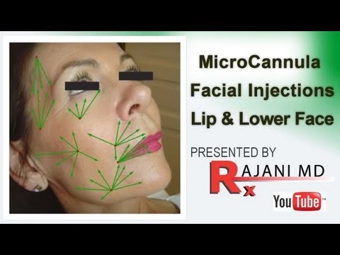Watch MicroCannula Facial Injections-Lip and Lower Face - YouTube