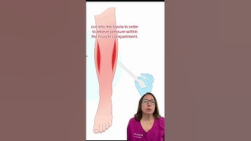 Compartment Syndrome: Medical Surgical SHORT | @LevelUpRN