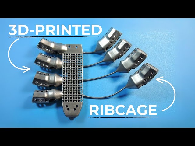 3-D Printer Uses Metal To Make Custom Rib Cage For Cancer Patient