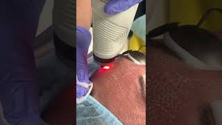 Co2 Treatment Tampa Florida