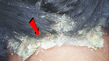 Dandruff Shampoo and Scratching, Itchy Dry Scalp, Huge Flake - Psoriasis #123
