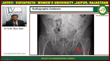 JAYOTI VIDYAPEETH -Practice of Medicine - Osteoarthritis