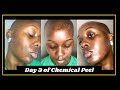 Skincare vlog day 3 pm of my chemical peel for hyperpigmentation  mikara reid