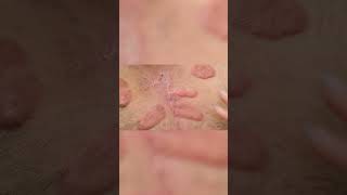 Man Goes Through Mind Blowing Transformation After Keloid Surgery! #badskinclinic #shorts