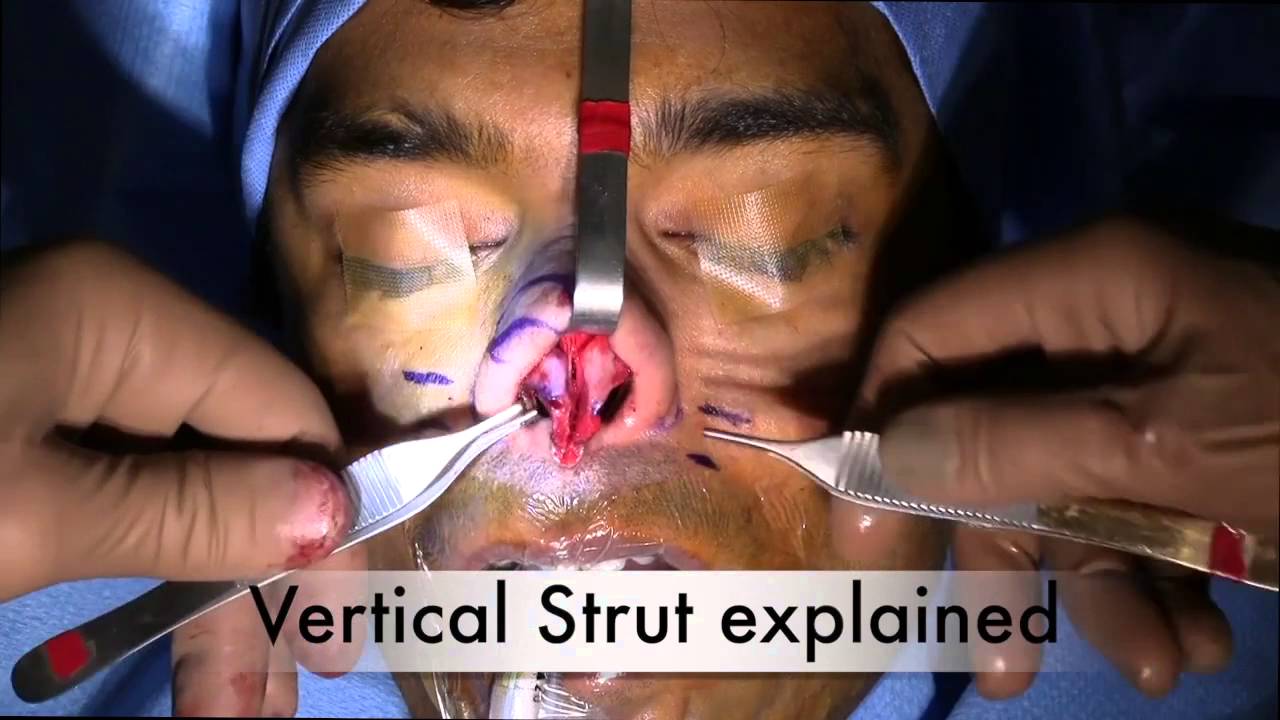 NatraNose Septoplasty Excise Lesion Case Study by Dr. Miller