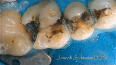 Safe Amalgam removal by Dr Sarkissian