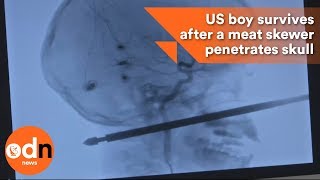 US boy survives after a meat skewer penetrates skull