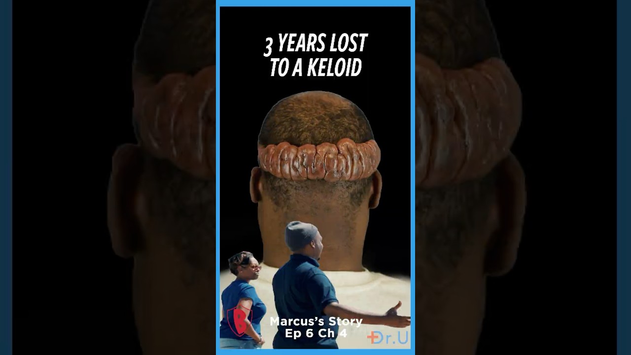 His Keloid Changed 3 Years of His Life | Marcus’ Story