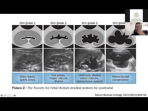 Vídeo: La infecció renal pot aparèixer a l'ecografia?