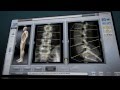 Renaissance Spine Surgery - How it Works