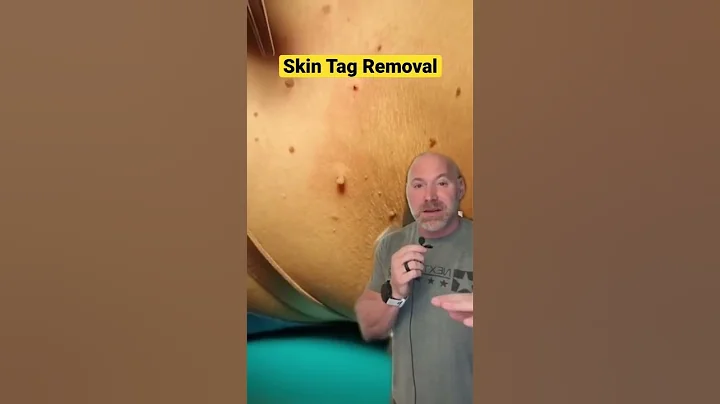 Cutting Off Skin Tags with Scissors 😱 #shorts