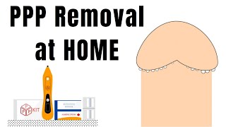 Pearly Penile Papules treatment at home - (PPP removal with PPP KIT)