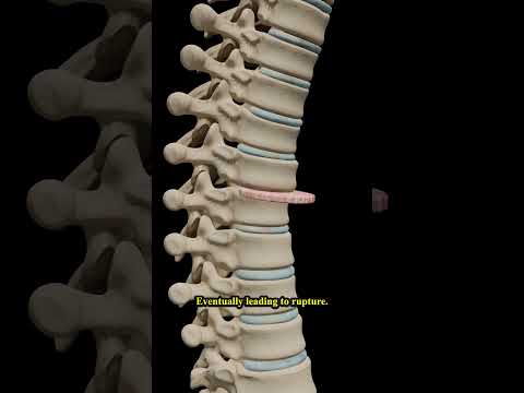 Spinal Surgery Explained: