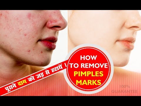 How To Remove Pimple Marks, Dark Spots, Reduce Black Heads at Home in Hindi