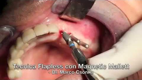 Dr M Csonka_Flapless technique with Magnetic Mallet