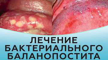 Лечение бактериального баланопостита
