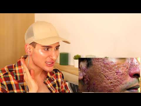 5 ways to remove acne scars - 5 ways to remove acne scars