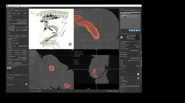 Segmenting CT Data in ORS Dragonfly