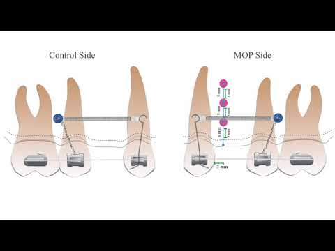 Three dimensional assessment of micro-osteoperforations on the rate of the tooth movement