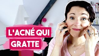 Acné vulgaire ou acné fongique ? (une différence de taille)