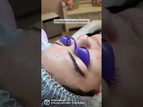 It's Peeling Season!