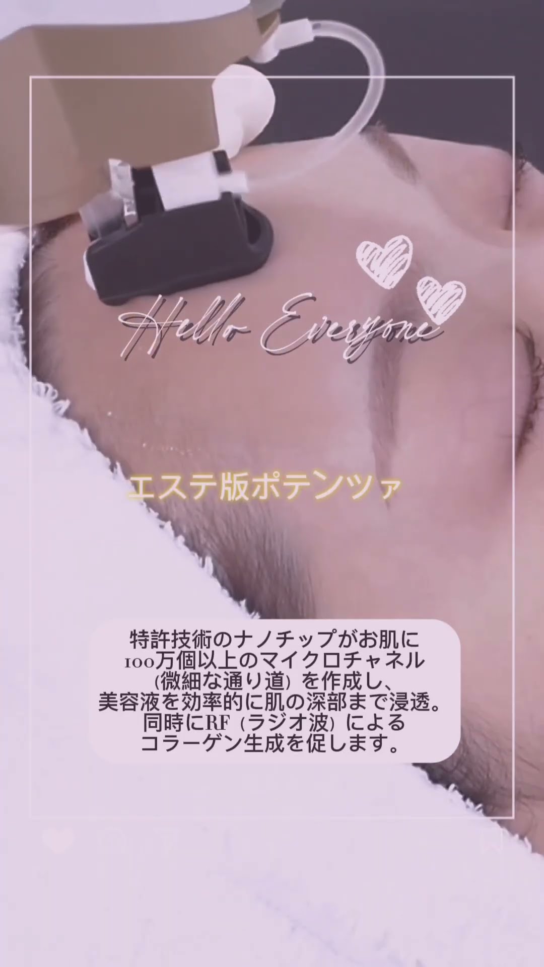 エステ版ポテンツァ✨ナノスキンニードル - YouTube