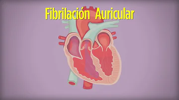 ¿Se puede vivir con fibrilación auricular durante años?