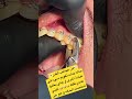 خلع الضرس في ثواني عجائب القدر Miracle Dentist Braces Dr Eslam Nabil Teeth تقويم أسنان خلع الضرس في ثواني عجائب القدر Miracle Dentist Braces Dr Eslam Nabil Teeth تقويم أسنان