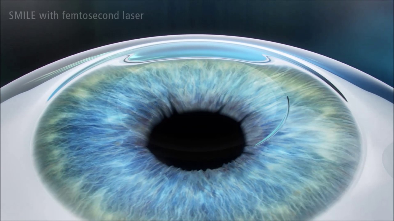 Fort Worth Laser Eye Surgery >