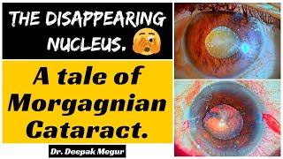 The Disappearing Nucleus The Tale Of Morgagnian Cataract - Dr Deepak Megur