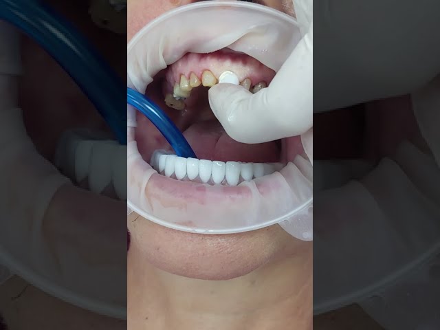 Temporary Cementation of Single Metal Ceramic Crowns #shorts class=