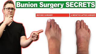 Bunion Surgery SECRETS & FAST Recovery [Bunionectomy vs Lapiplasty]