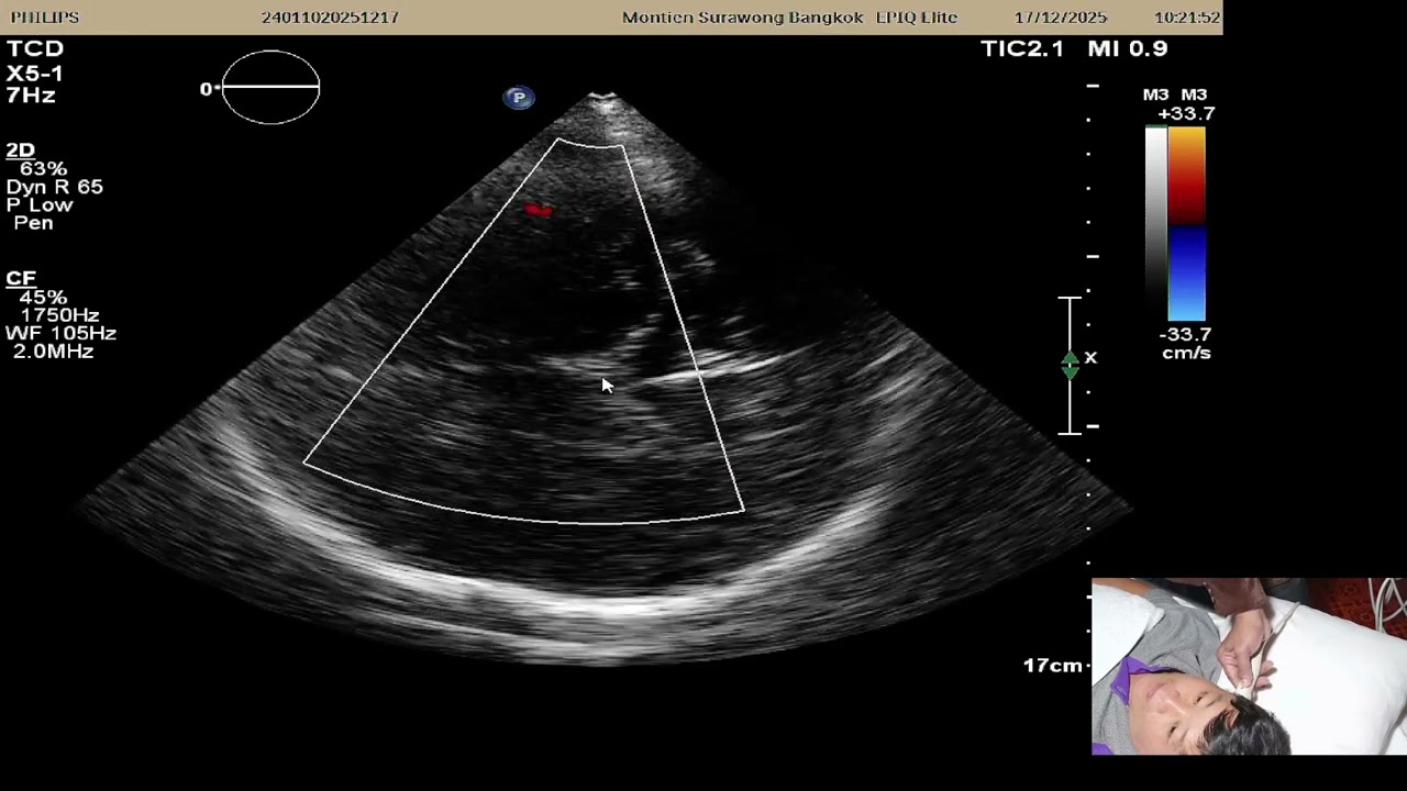Live demon Tranacranial Doppler by Dr. Pradeep
