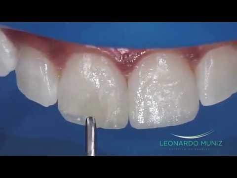 Vídeo: As luminárias podem alongar os dentes?