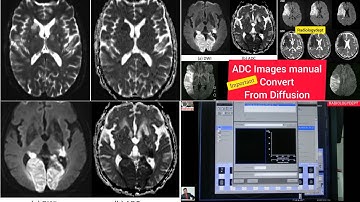 How To Convert ADC (Apparent diffusion coefficient) From (DWI) Diffusion-weighted imaging || #mri
