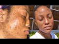 SKINCARE ROUTINE FOR OILY ACNE PRONE SENSITIVE SKIN || How I deal with Hyper Pigmentation & Texture