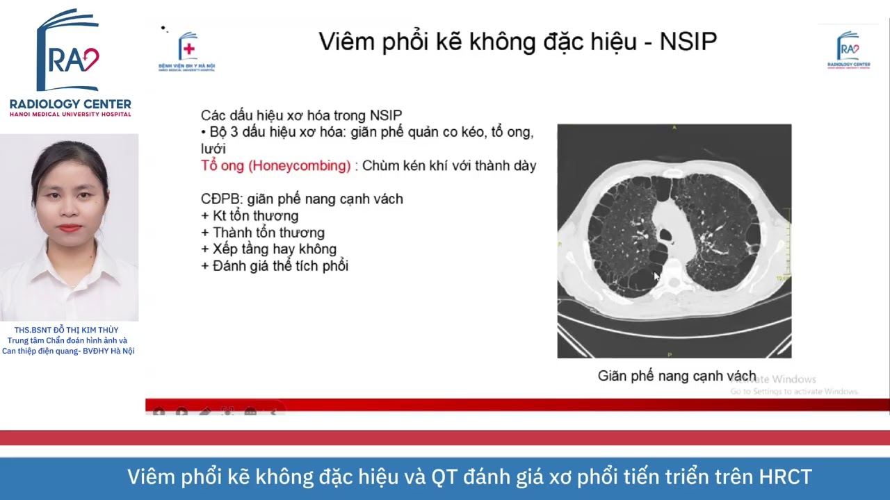 VIÊM PHỔI KẼ KHÔNG ĐẶC HIỆU (NSIP) VÀ QUY TRÌNH ĐÁNH GIÁ XƠ PHỔI TIẾN TRIỂN (PPF) TRÊN HRCT