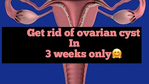 Get rid of Ovarian cyst in 3 weeks
