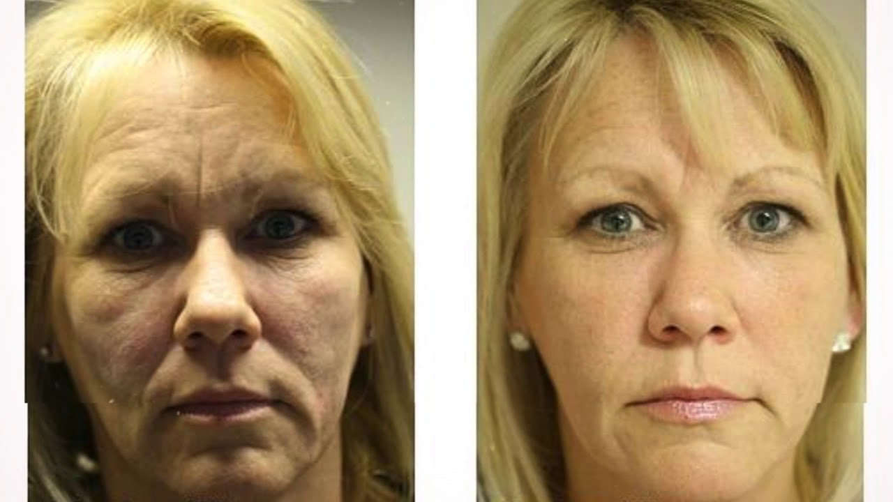 South Wales Botox and Facial Aesthetics - The Mayhill