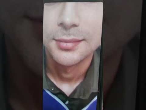 لیفت سانترال لب در کلینیک آرتین جراحی زیبایی     